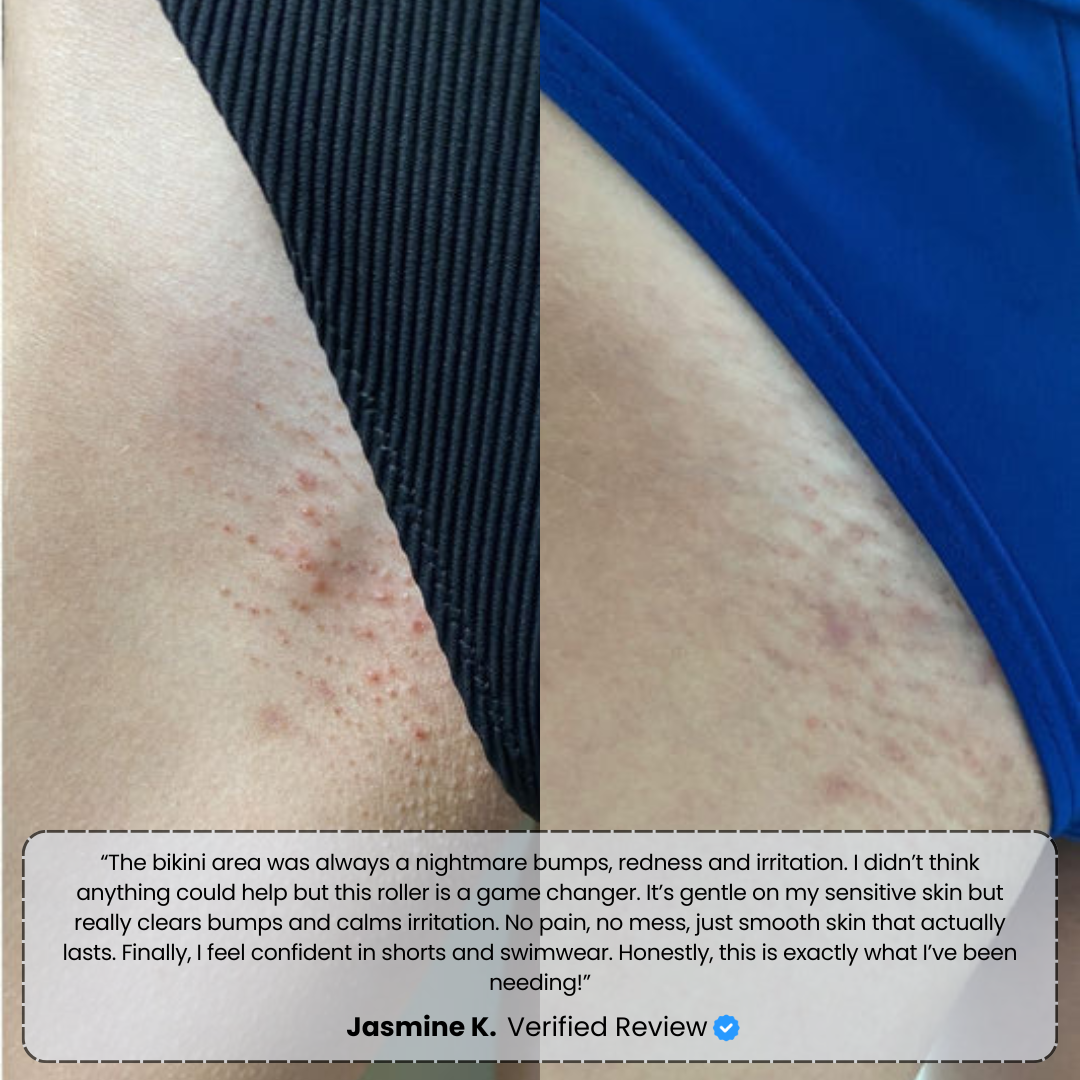 Banex | Ingrown Hair Treatment Serum