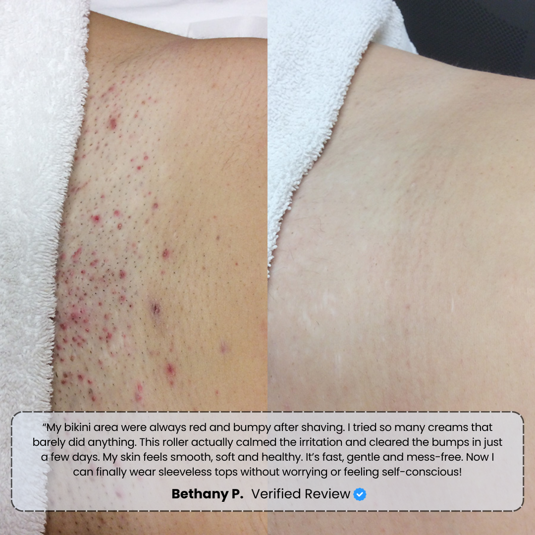 Banex | Ingrown Hair Treatment Serum